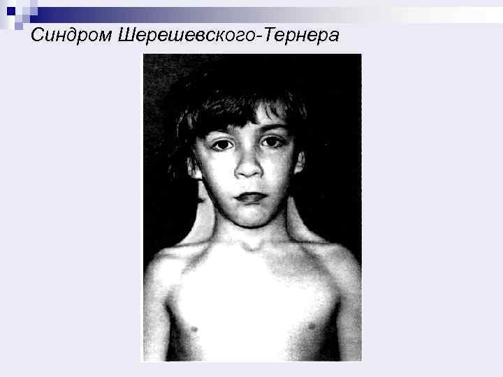 Синдром Шерешевского-Тернера 