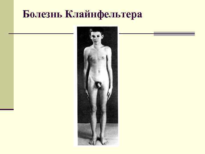 Болезнь Клайнфельтера 