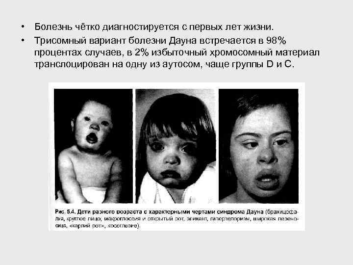  • Болезнь чётко диагностируется с первых лет жизни. • Трисомный вариант болезни Дауна