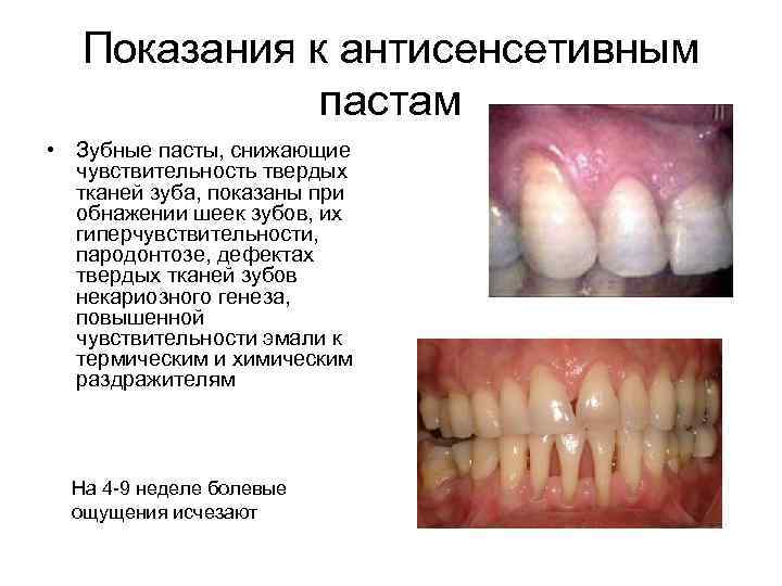 Показания к антисенсетивным пастам • Зубные пасты, снижающие чувствительность твердых тканей зуба, показаны при
