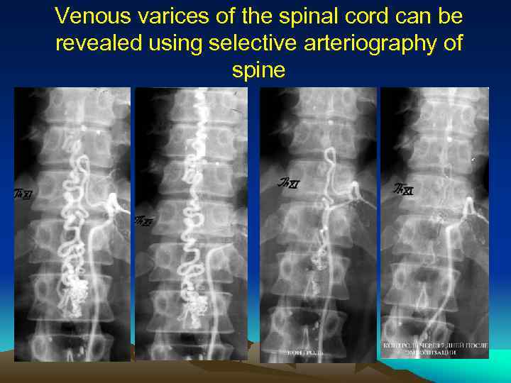 Venous varices of the spinal cord can be revealed using selective arteriography of spine