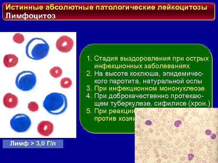 Истинные абсолютные патологические лейкоцитозы Лимфоцитоз 1. Стадия выздоровления при острых инфекционных заболеваниях 2. На