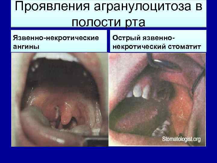 Проявления агранулоцитоза в полости рта Язвенно-некротические ангины Острый язвеннонекротический стоматит 