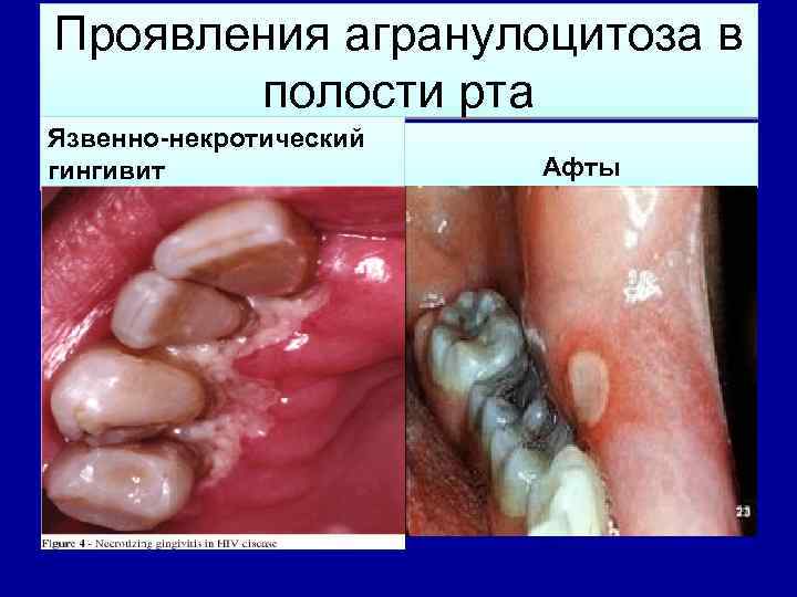 Проявления агранулоцитоза в полости рта Язвенно-некротический гингивит Афты 