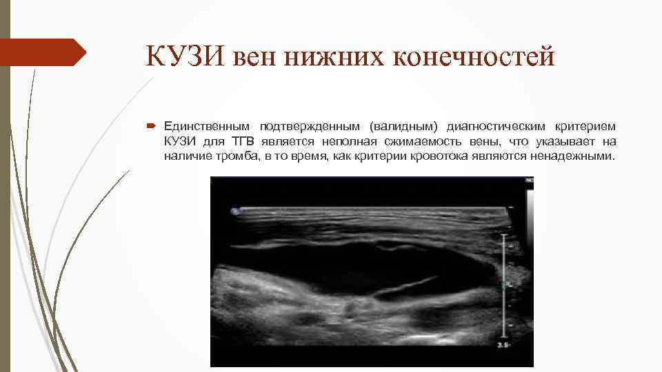 Код мкб тромбоз глубоких вен нижних конечностей. Тромбоэмболия пальцевой артерии фото и описание. М режим на легочной артерии. Волна а.
