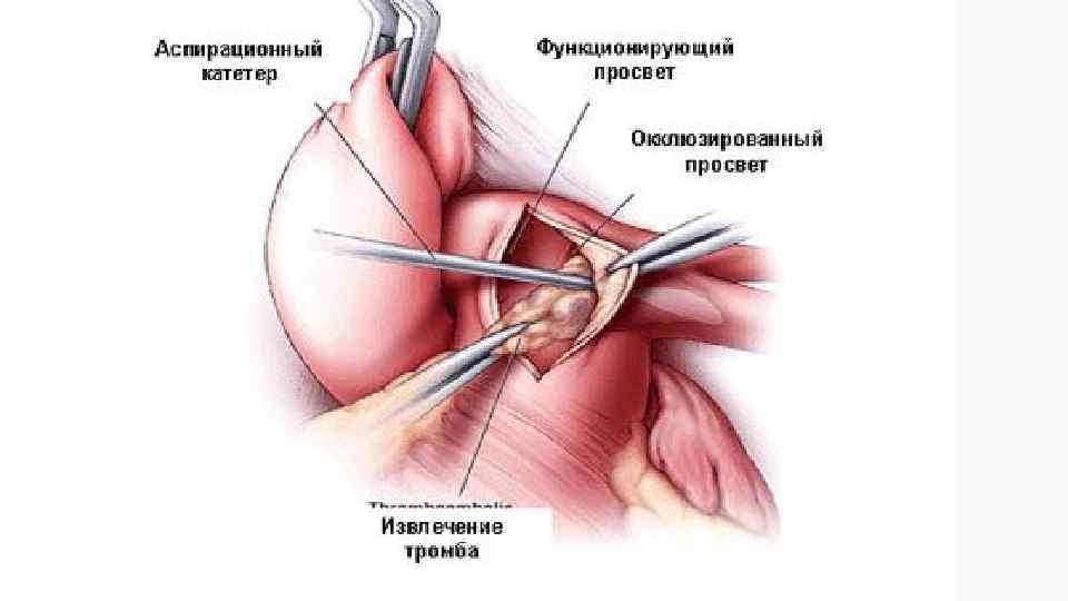 Операции при тромбозе. Хирургическая тромбэктомия при Тэла. Катетерная эмболэктомия при Тэла. Тэла катетерная тромбэктомия. Эмболэктомия из легочной артерии.