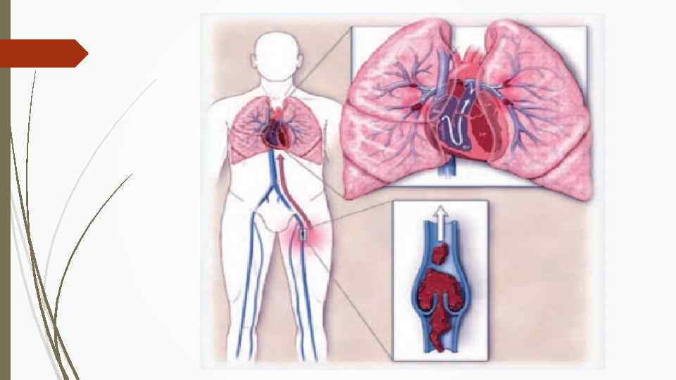 Тромбоз тэла. Тромбоэмболия легочной артерии. Тромбофлебит легочной артерии. Эмболия тромбом легочной артерии.