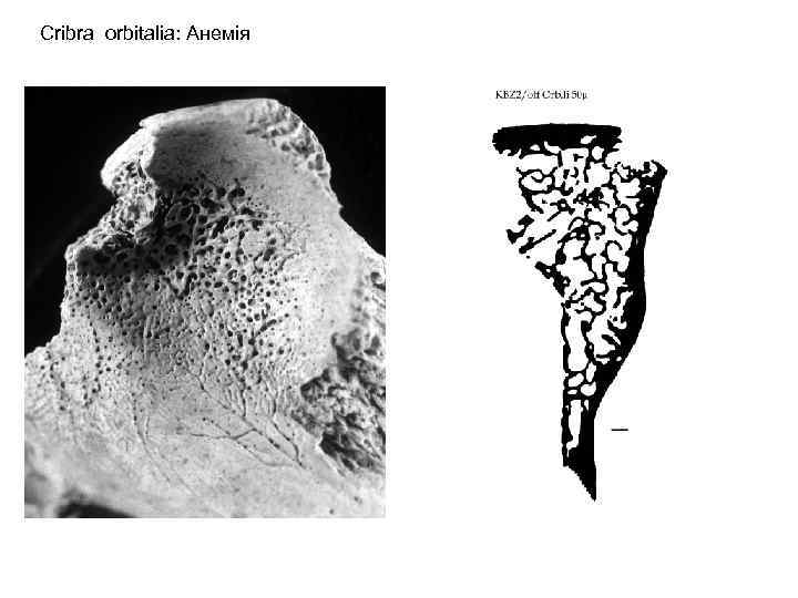 Cribra orbitalia: Анемія 