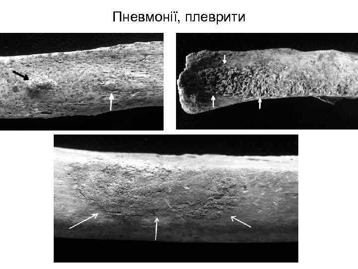 Пневмонії, плеврити 