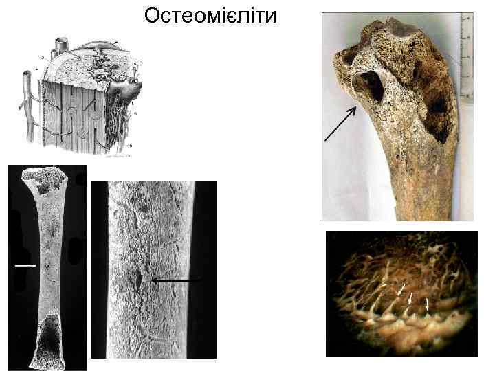 Остеомієліти 