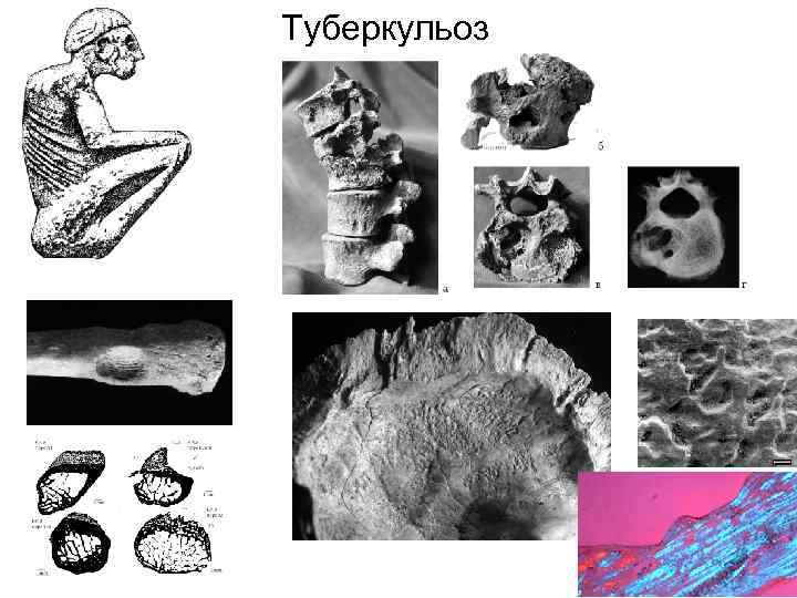 Туберкульоз 