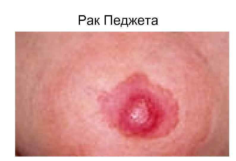 Рак Педжета 