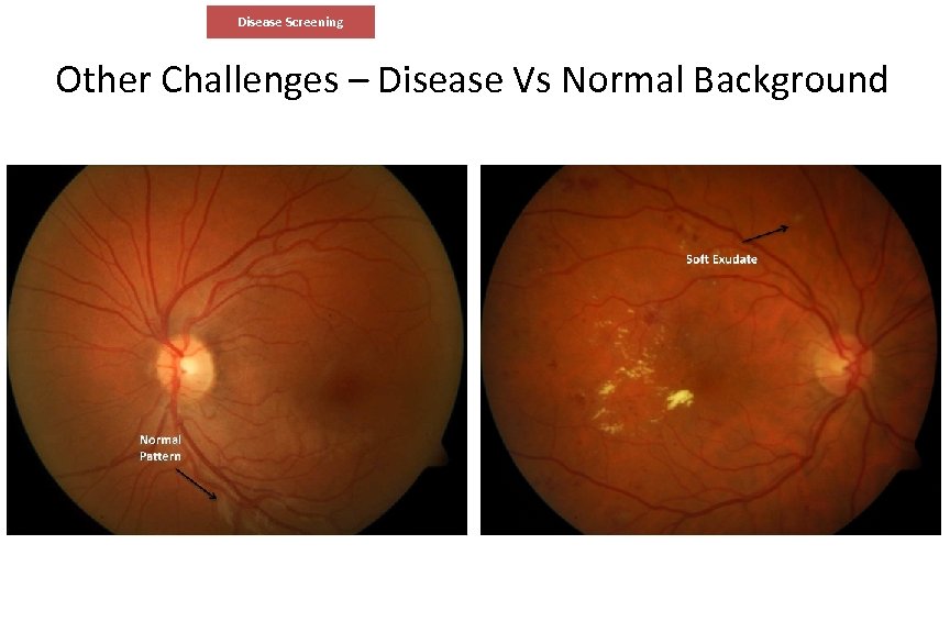 Disease Screening Other Challenges – Disease Vs Normal Background 