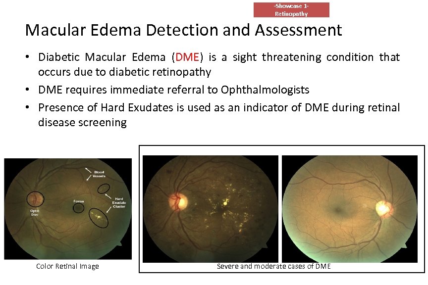 -Showcase 1 Retinopathy Macular Edema Detection and Assessment • Diabetic Macular Edema (DME) is