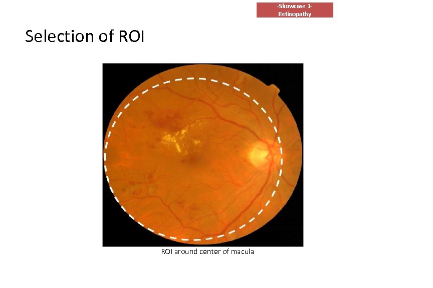 -Showcase 1 Retinopathy Selection of ROI around center of macula 