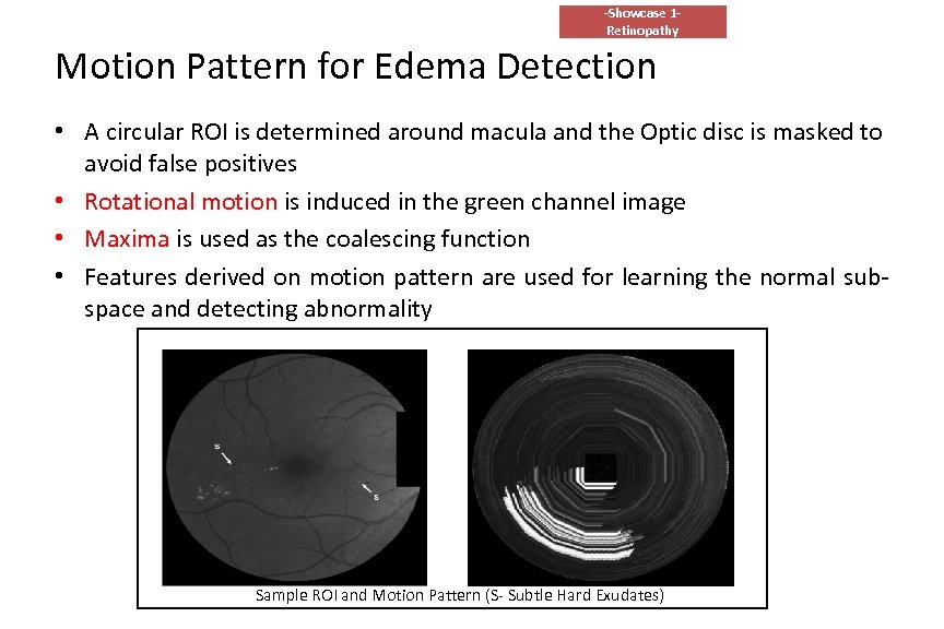 -Showcase 1 Retinopathy Motion Pattern for Edema Detection • A circular ROI is determined