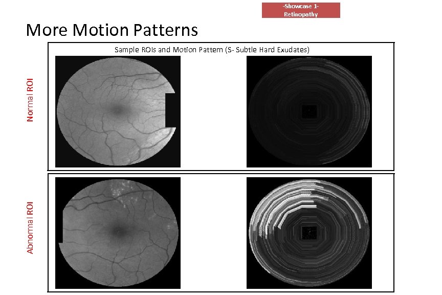 More Motion Patterns -Showcase 1 Retinopathy Abnormal ROI Normal ROI Sample ROIs and Motion