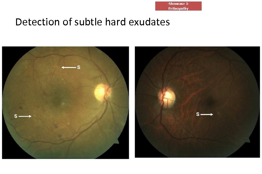 -Showcase 1 Retinopathy Detection of subtle hard exudates 