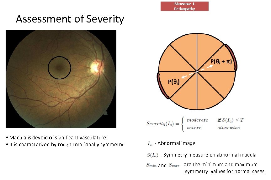 -Showcase 1 Retinopathy Assessment of Severity • Macula is devoid of significant vasculature •