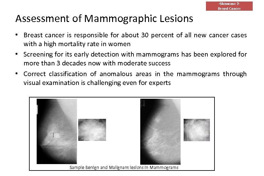 -Showcase 2 Breast Cancer Assessment of Mammographic Lesions • Breast cancer is responsible for