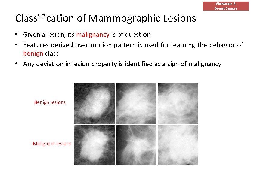 -Showcase 2 Breast Cancer Classification of Mammographic Lesions • Given a lesion, its malignancy