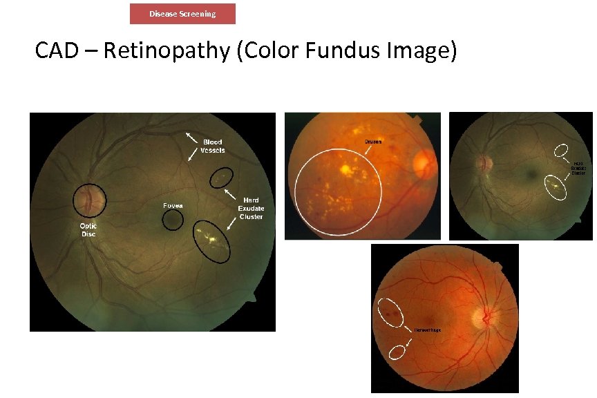 Disease Screening CAD – Retinopathy (Color Fundus Image) 