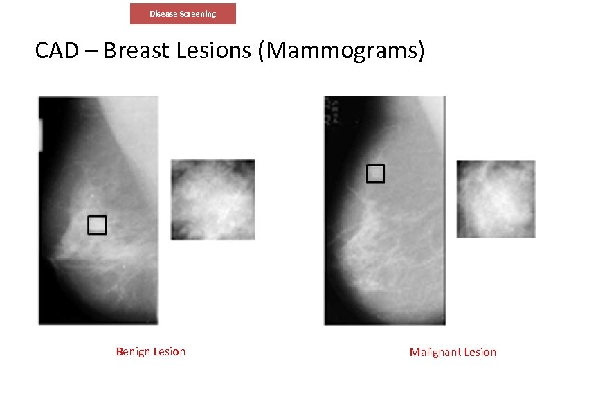 Disease Screening CAD – Breast Lesions (Mammograms) Benign Lesion Malignant Lesion 