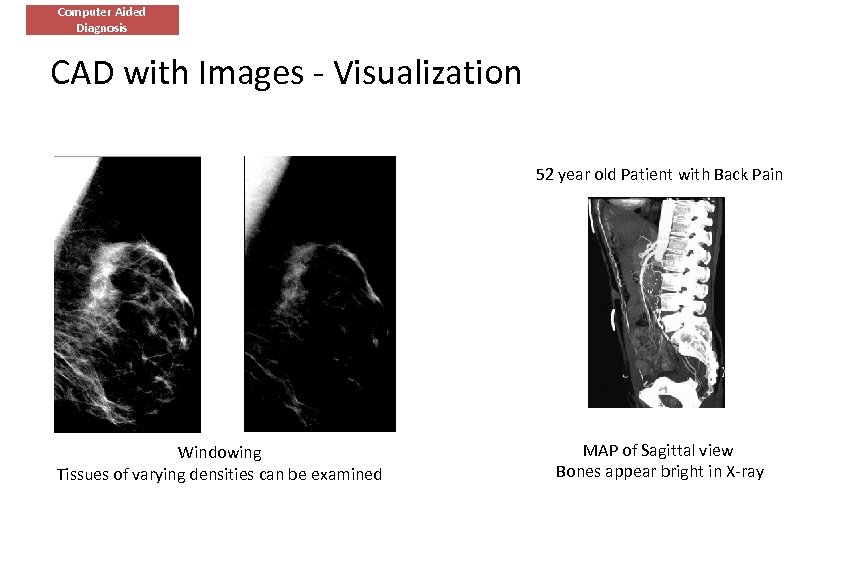 Computer Aided Diagnosis CAD with Images - Visualization 52 year old Patient with Back