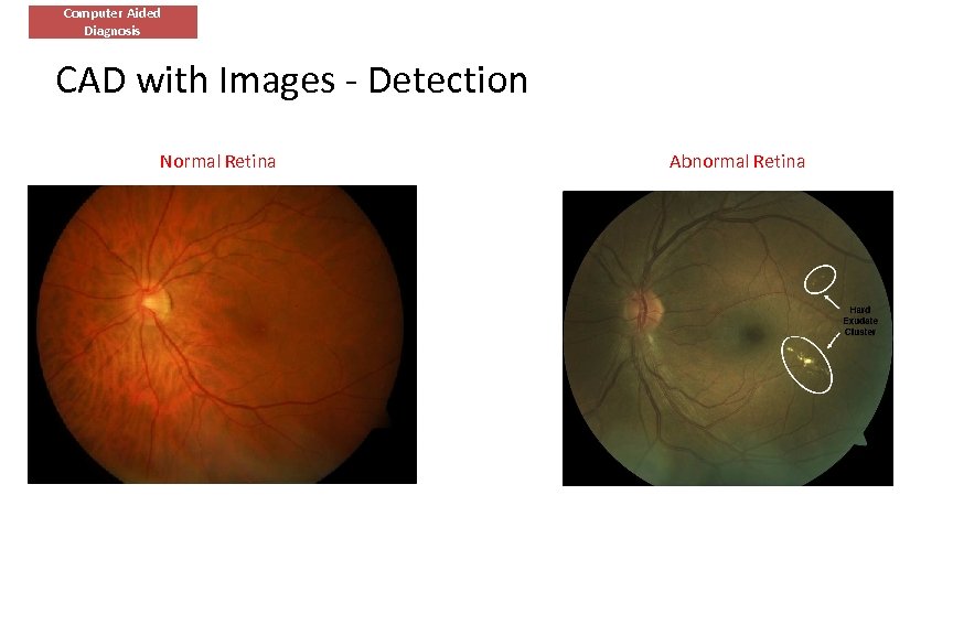 Computer Aided Diagnosis CAD with Images - Detection Normal Retina Abnormal Retina 