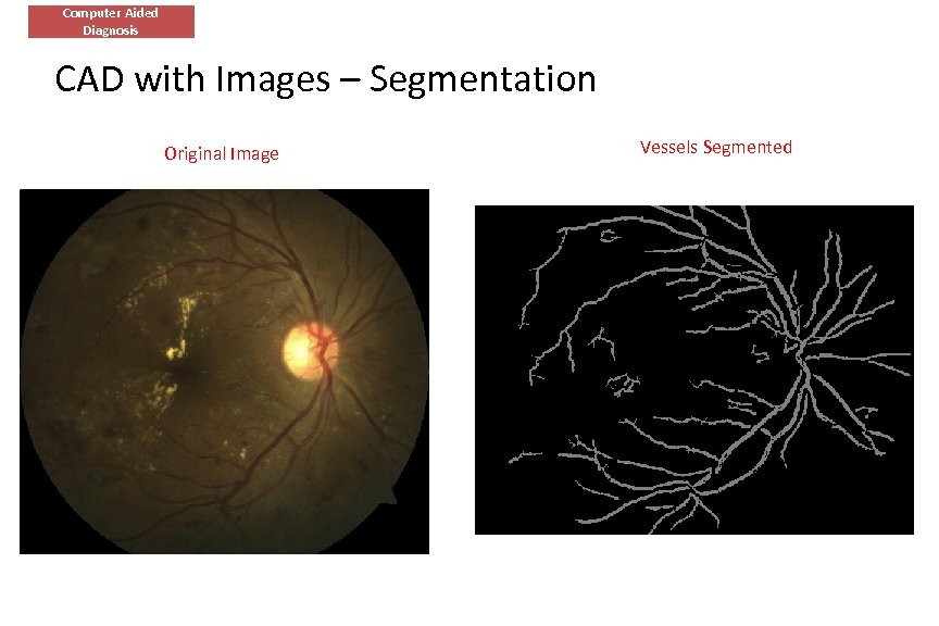 Computer Aided Diagnosis CAD with Images – Segmentation Original Image Vessels Segmented 