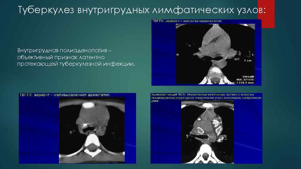 Туберкулез внутригрудных лимфатических узлов: Внутригрудная полиаденопатия – объективный признак латентно протекающей туберкулезной инфекции. 