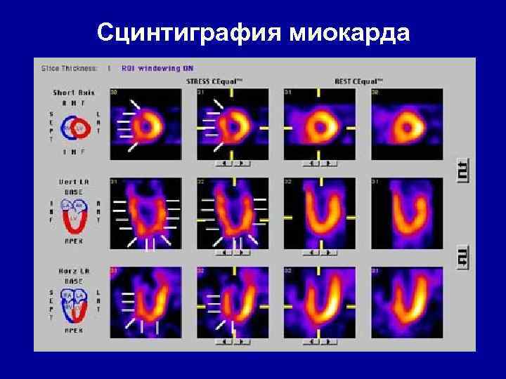 Презентация сцинтиграфия миокарда