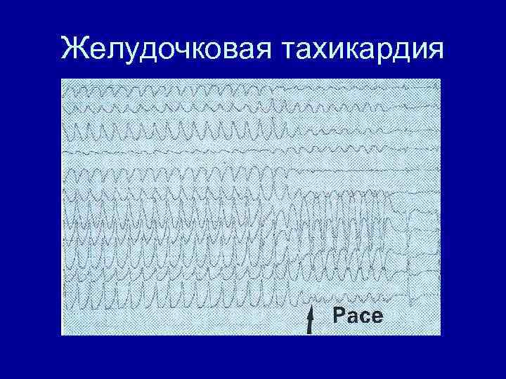 Желудочковая тахикардия 