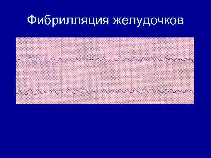 Фибрилляция желудочков 