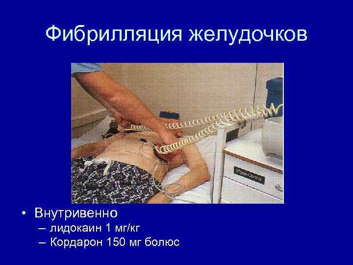 Фибрилляция желудочков • Внутривенно – лидокаин 1 мг/кг – Кордарон 150 мг болюс 