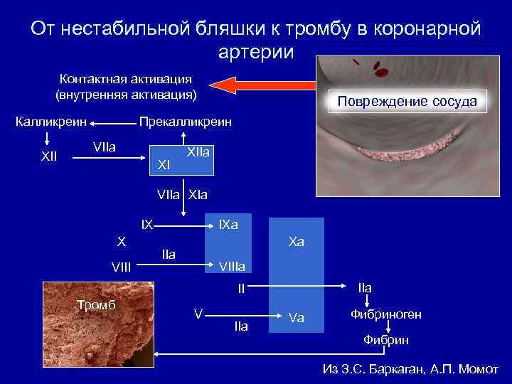 От нестабильной бляшки к тромбу в коронарной артерии Контактная активация (внутренняя активация) Калликреин XII