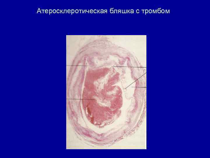Атеросклеротическая бляшка с тромбом 