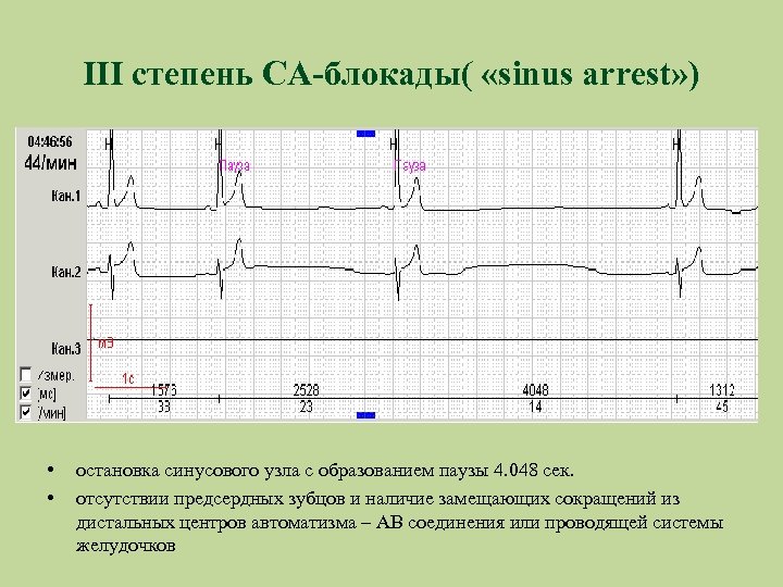 III степень СА-блокады( «sinus arrest» ) • • остановка синусового узла с образованием паузы