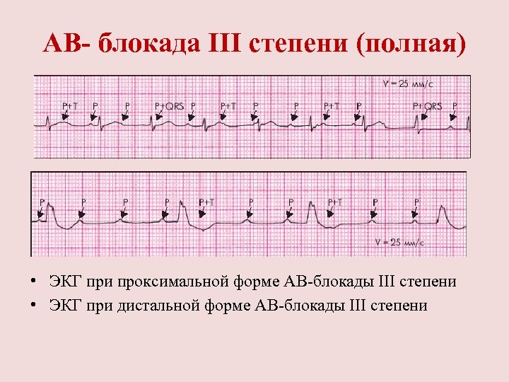 АВ- блокада III степени (полная) • ЭКГ при проксимальной форме АВ блокады III степени