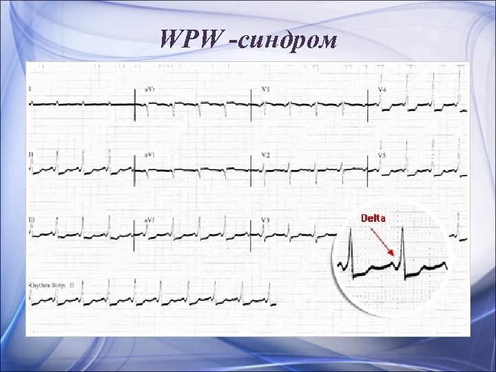 WPW -синдром 
