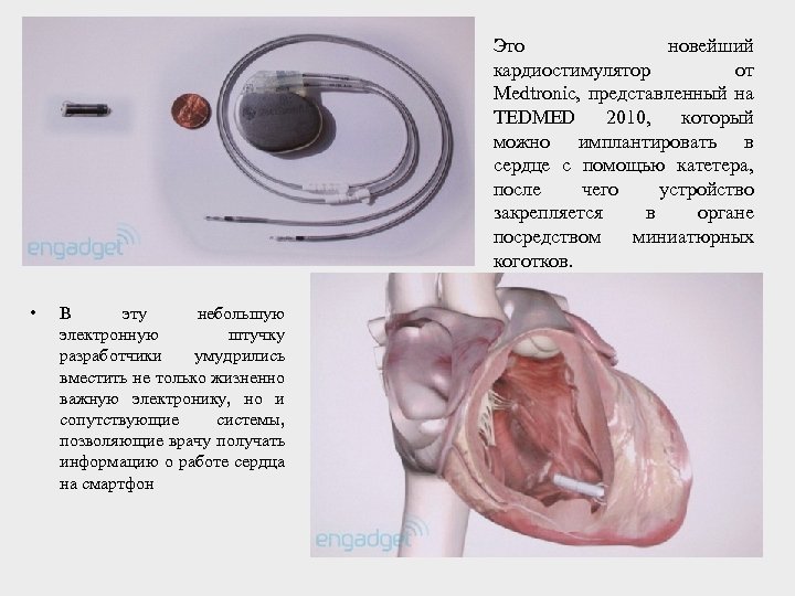 Это новейший кардиостимулятор от Medtronic, представленный на TEDMED 2010, который можно имплантировать в сердце