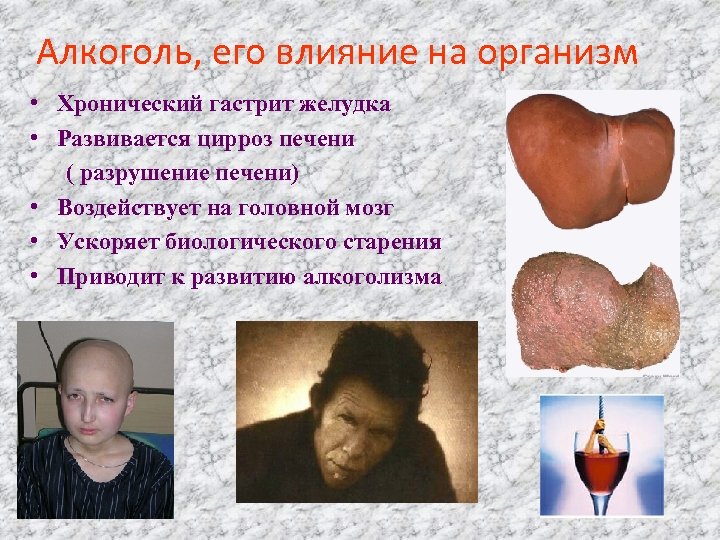 Алкоголь, его влияние на организм • Хронический гастрит желудка • Развивается цирроз печени (