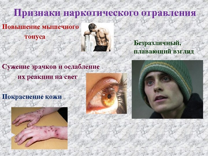 Признаки наркотического отравления Повышение мышечного тонуса Сужение зрачков и ослабление их реакции на свет