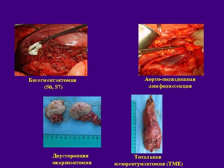 Бисегментэктомия (S 6, S 7) Двусторонняя овариоэктомия Аорто-подвздошная лимфодиссекция Тотальная мезоректумэктомия (ТМЕ) 