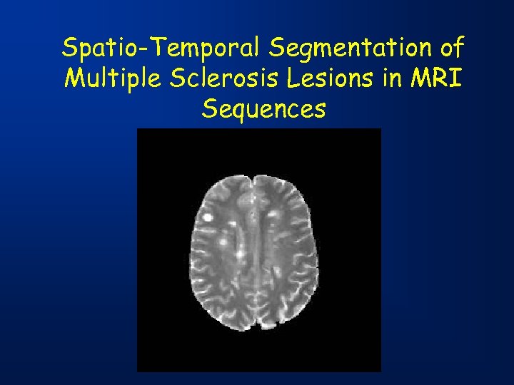 Spatio-Temporal Segmentation of Multiple Sclerosis Lesions in MRI Sequences 