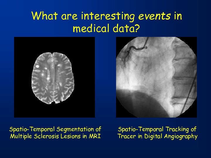 What are interesting events in medical data? Spatio-Temporal Segmentation of Multiple Sclerosis Lesions in
