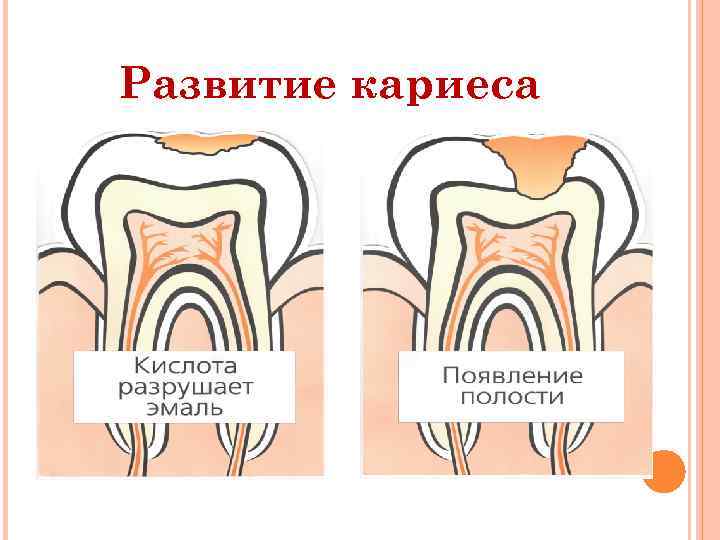 Развитие кариеса 