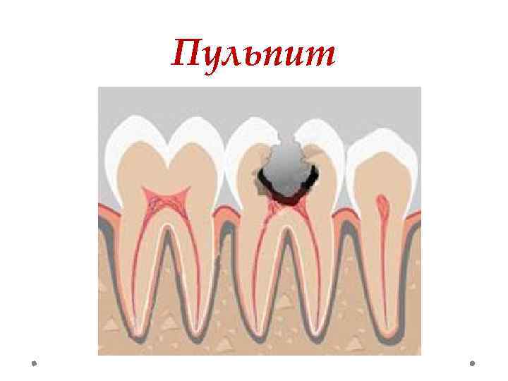 Виды пульпита