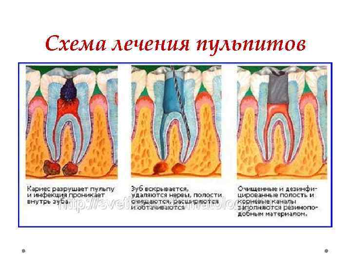 Методы лечения периодонтита презентация