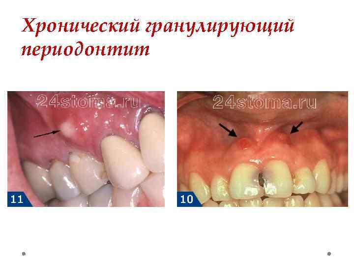 Хронический гранулирующий периодонтит 